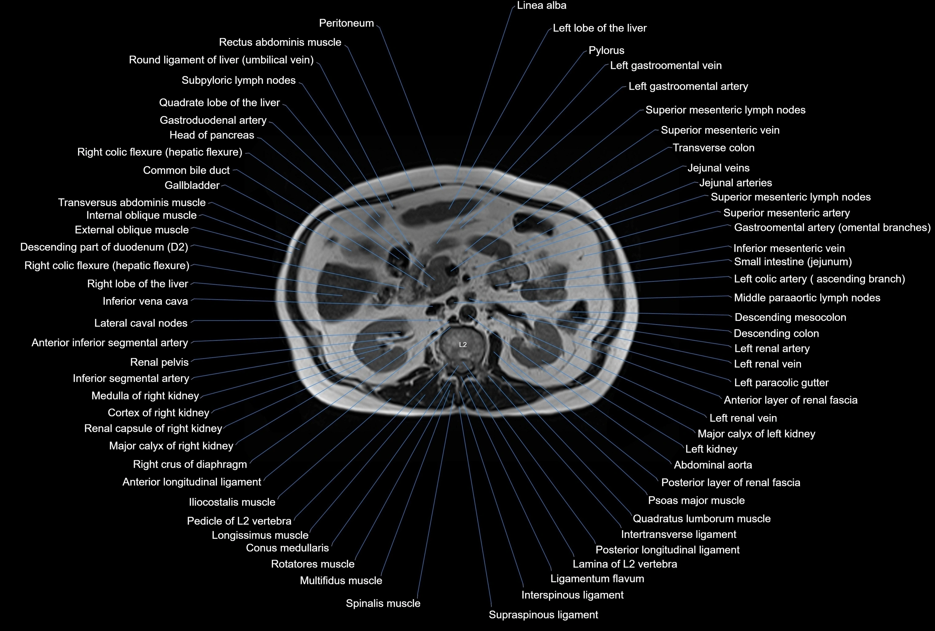 MRI Abdomen axial cross sectional anatomy radiology  image-img-00001-00021.webp